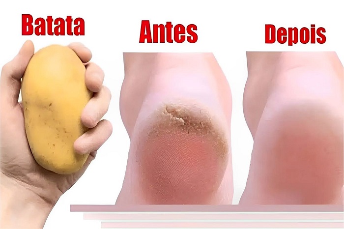 Isso deixa os pés lisos e sem rachaduras com ingredientes simples