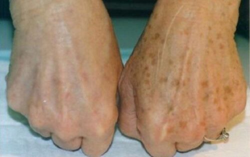 Elimine Manchas de Idade com uma Receita Simples e Barata