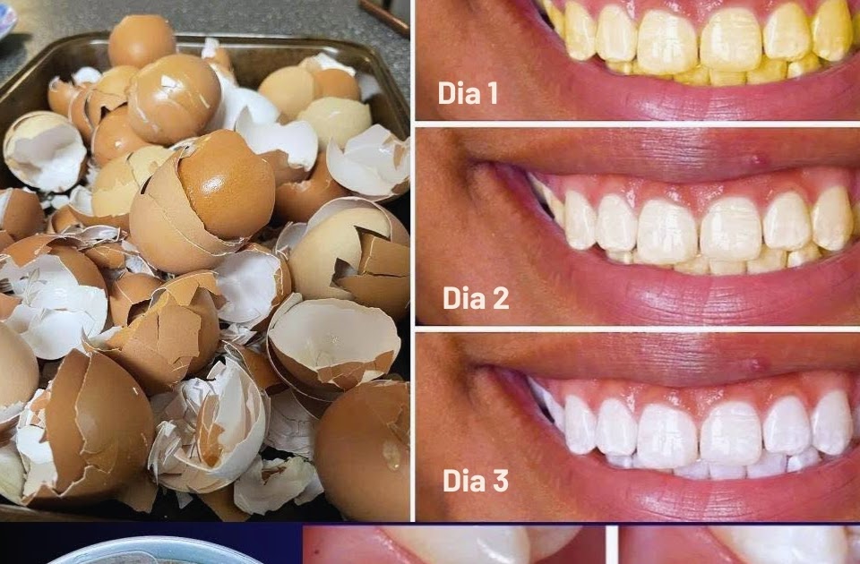 Após 5 Minutos, Dentes Amarelados Ficam Branco-Pérola — O Suave Segredo ...
